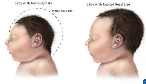 Virus Zika vào Việt Nam, phụ nữ mang thai nên làm gì?