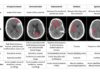 Ứng dụng Deep Learning có thể chẩn đoán chính xác tình trạng xuất huyết não