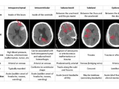 Ứng dụng Deep Learning có thể chẩn đoán chính xác tình trạng xuất huyết não