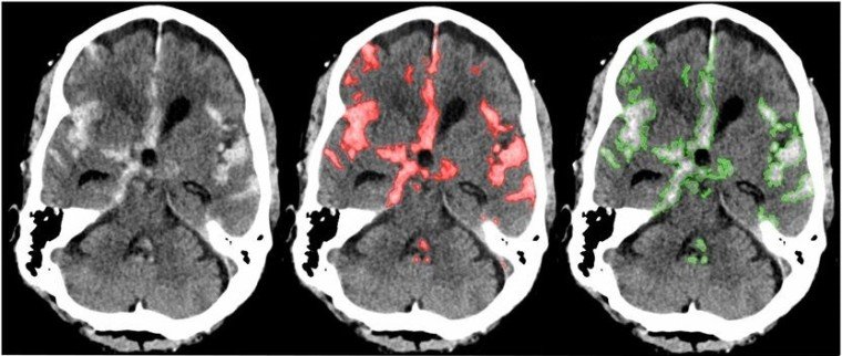 Ứng dụng học sâu có thể chẩn đoán chính xác tình trạng xuất huyết não