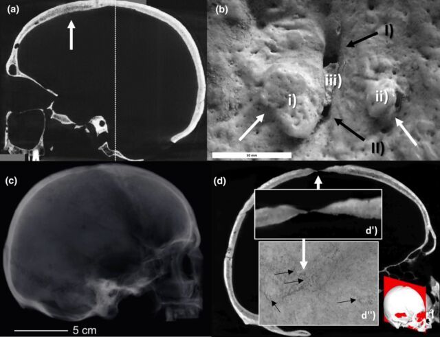 Các nhà khảo cổ tìm thấy bằng chứng về phẫu thuật khoan sọ vào thời Trung Cổ