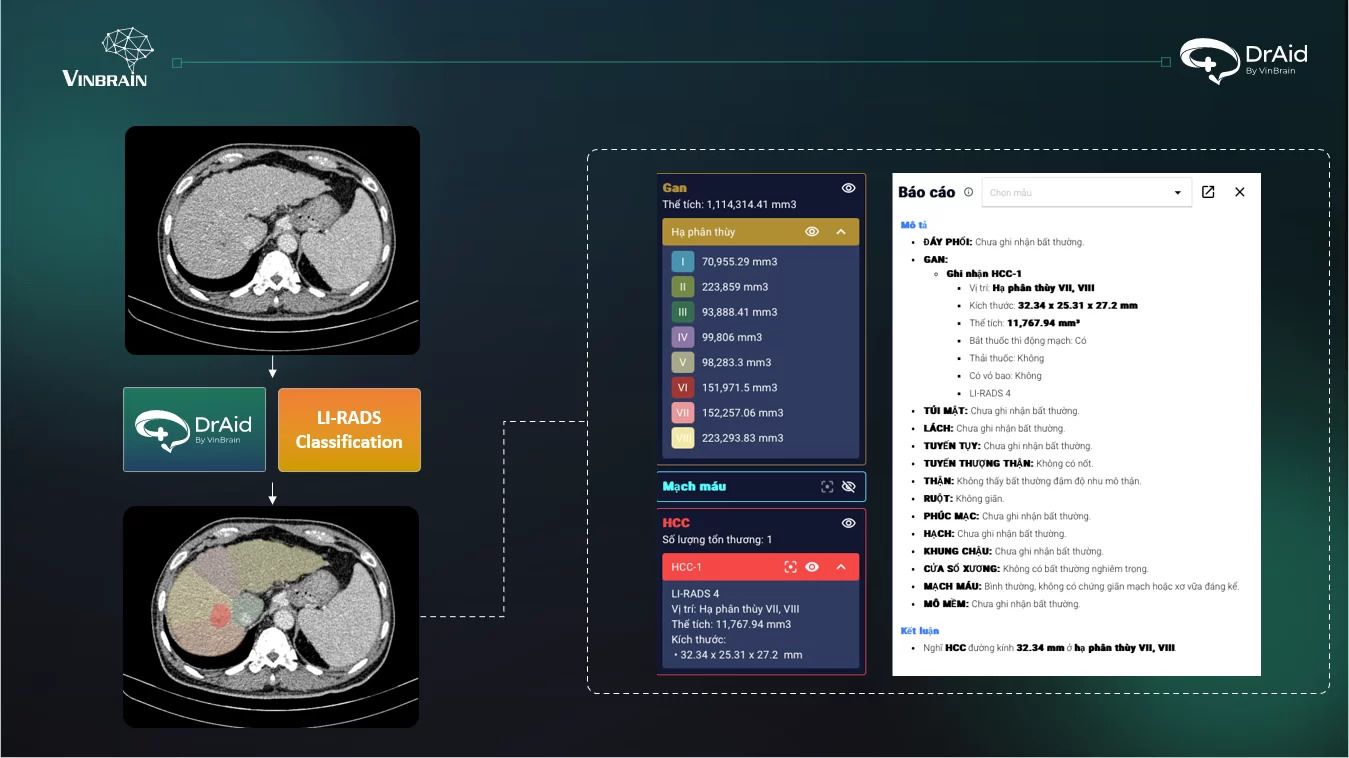 VinBrain triển khai phần mềm AI sàng lọc Lao tại Bệnh viện Phổi Trung ương